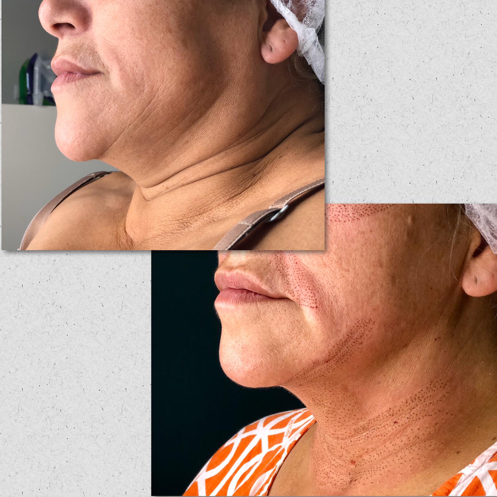 Fibroblast before and after